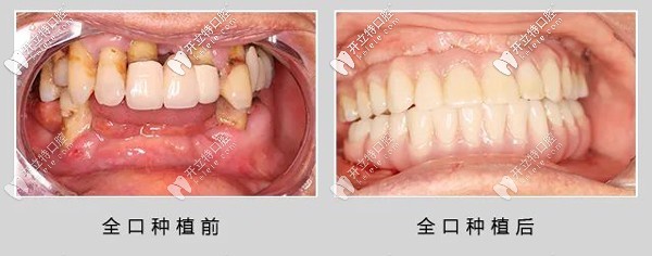 69歲退伍老兵做了ALL- on-6全口種植牙，感言：再活30年！