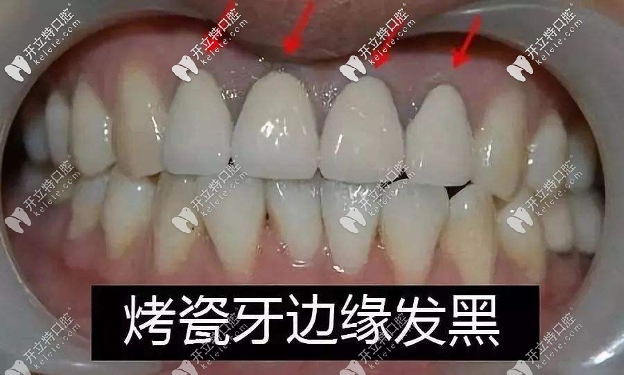 烤瓷牙的牙齦出現(xiàn)黑線怎么辦?這些修復(fù)方法你需要了解哈