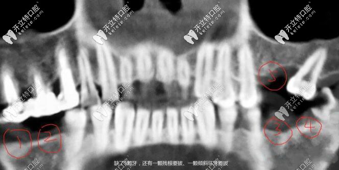 兩邊后牙連缺兩顆已有五六年,用瑞士ITI種植體半小時就解決