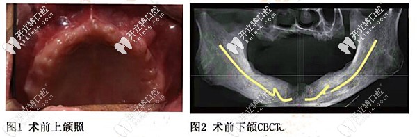 50多歲老人牙齒問題