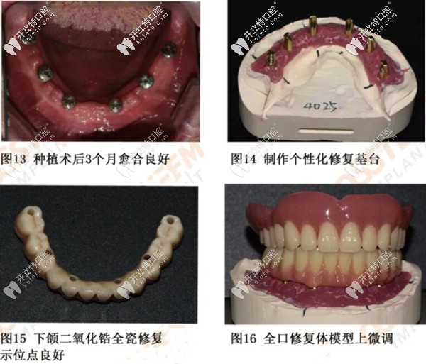 二期種植術(shù)后3個月