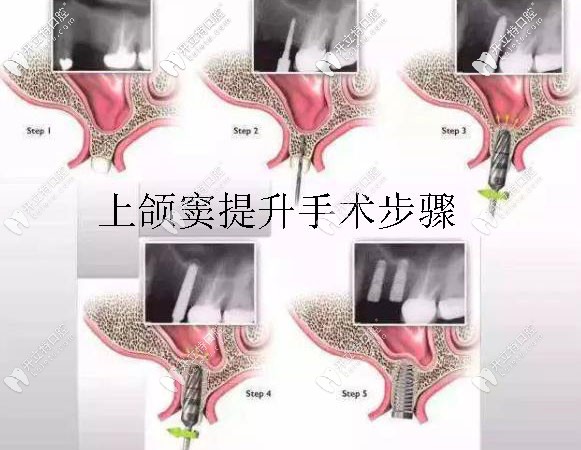 做上頜竇內(nèi)外提升手術的價格及恢復時間,這篇文章可告訴你