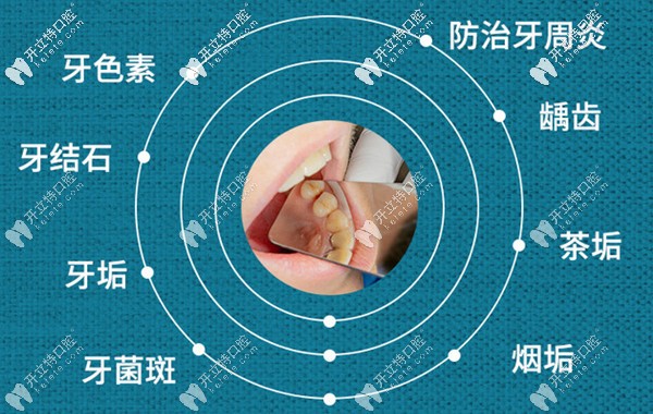 經(jīng)常洗牙的好處