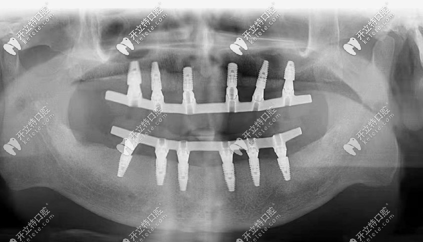 爺爺在北京平谷美銘做的allon6全口種植牙,上下各打了6個(gè)釘