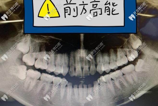 口腔CT片