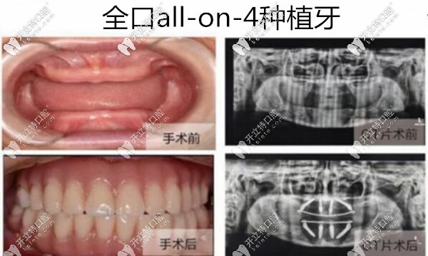 深圳美萊口腔周煒院長(zhǎng)全口種植牙<span style=