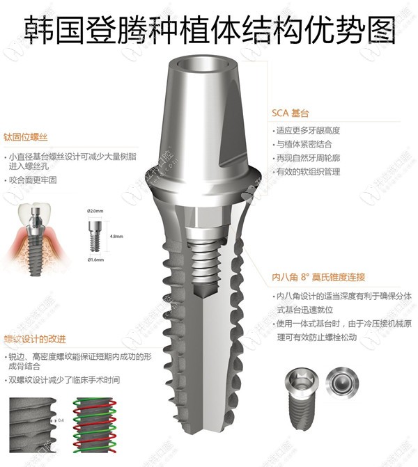 在曙光電子做韓國(guó)登騰進(jìn)口種植體信息