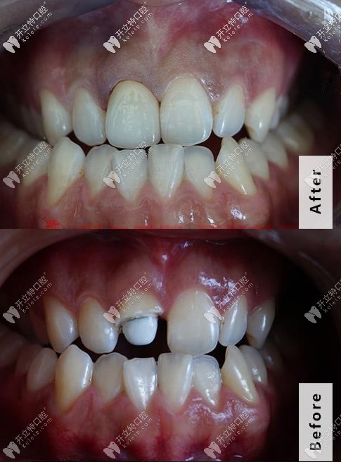 門牙斷了一半后選擇做纖維樁修復,帶全瓷冠才花了四千多哦